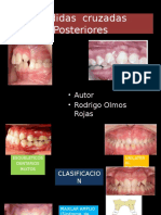 Mordida Cruzada Posterior