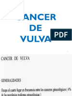 Cancer de Vulva