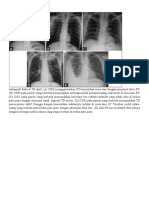 Radiografi Dada Di TB Aktif