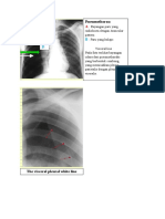 Gambar Pneumothoraks