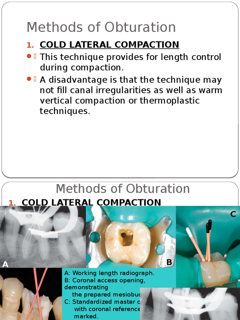 Obturation Techniques and Devices PDF Nature
