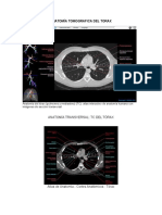 Anatomía Tomografica Del Torax