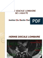 Hernie Discale Lombaire