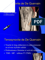 Tenosynovite de de Quervain