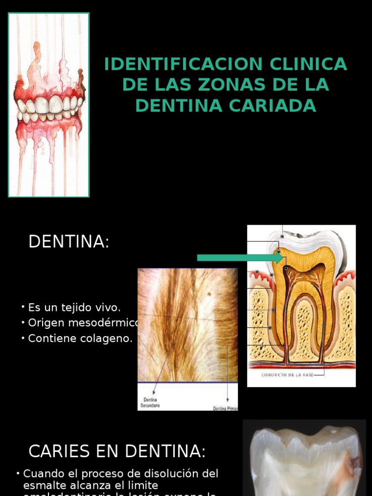 Zonas en Dentina Cariada | PDF | Dentina | Las bacterias