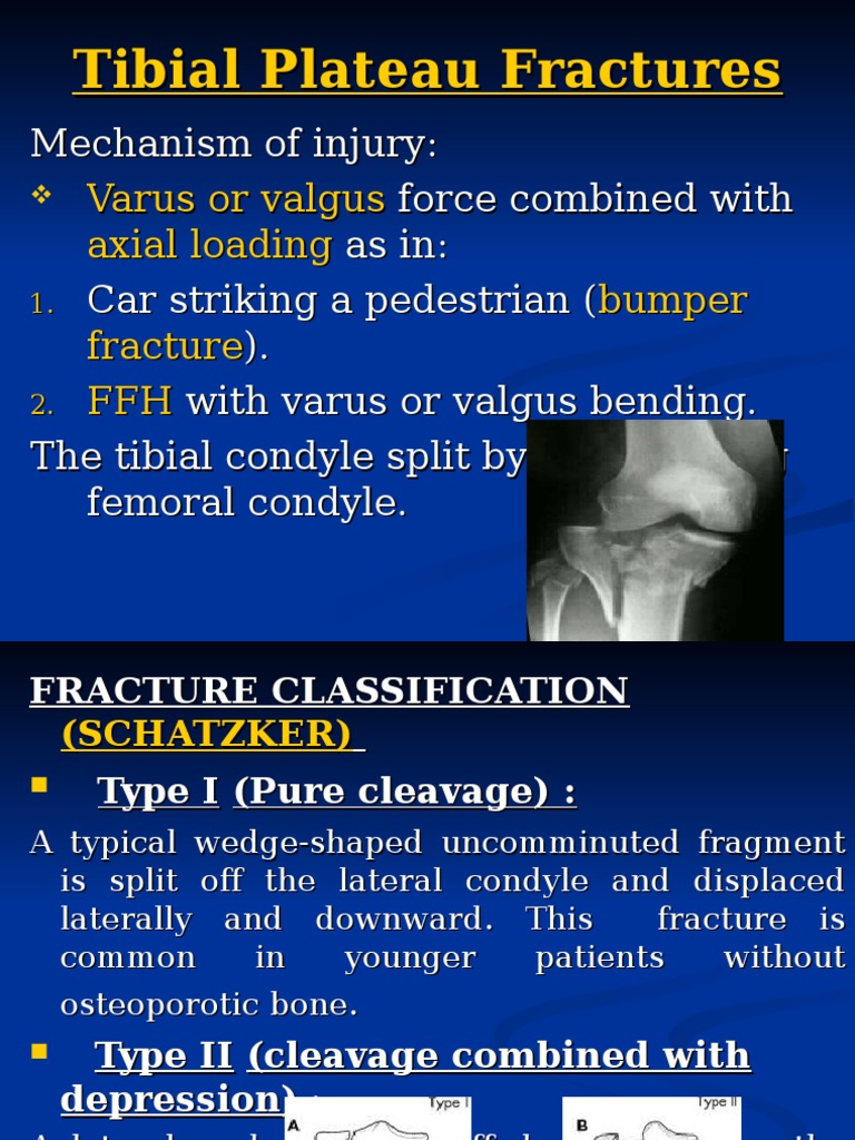 Tibial plateau thesis image