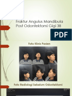 Fraktur Angulus Mandibula Post Odontektomi Gigi 38 PDF