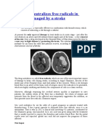 Uric Acid Neutralizes Free Radicals in Brain Damaged by A Stroke