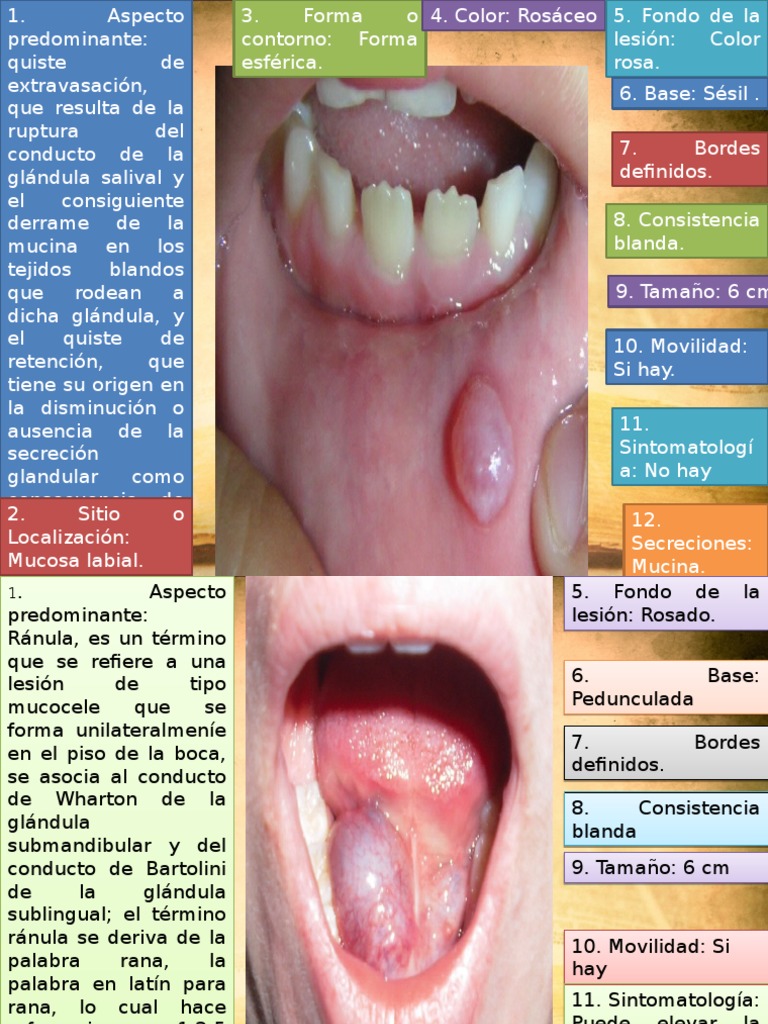Mucocele y Ránula | PDF | Enfermedades digestivas | Boca