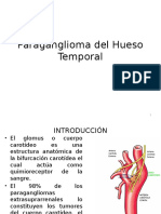 Paraganglioma Del Hueso Temporal o Glomus Yugular