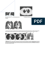 Coronal Axial CT Tracheobroncho Multiple Diverticula Megaly