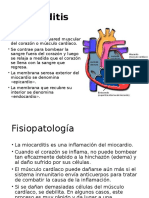 miocarditis