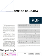 Sindrome de Brugada