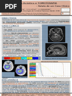 Neurinoma  do Acústico e TOMOTERAPIA