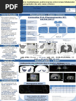 SBRT simultânea sobre metástases pulmonares síncronas bilaterais