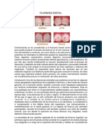 Fluorosis Dental 