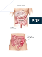 Patologia Del Volvulo de Sigmoides