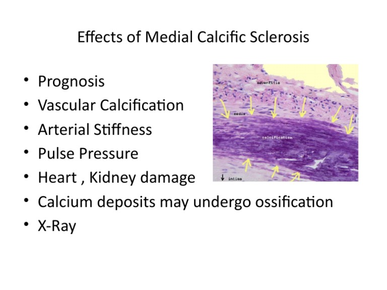 Medial Calcific Sclerosis Effects | PDF