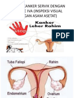 Deteksi Kanker Servik Dengan Metode Iva (Inspeksi