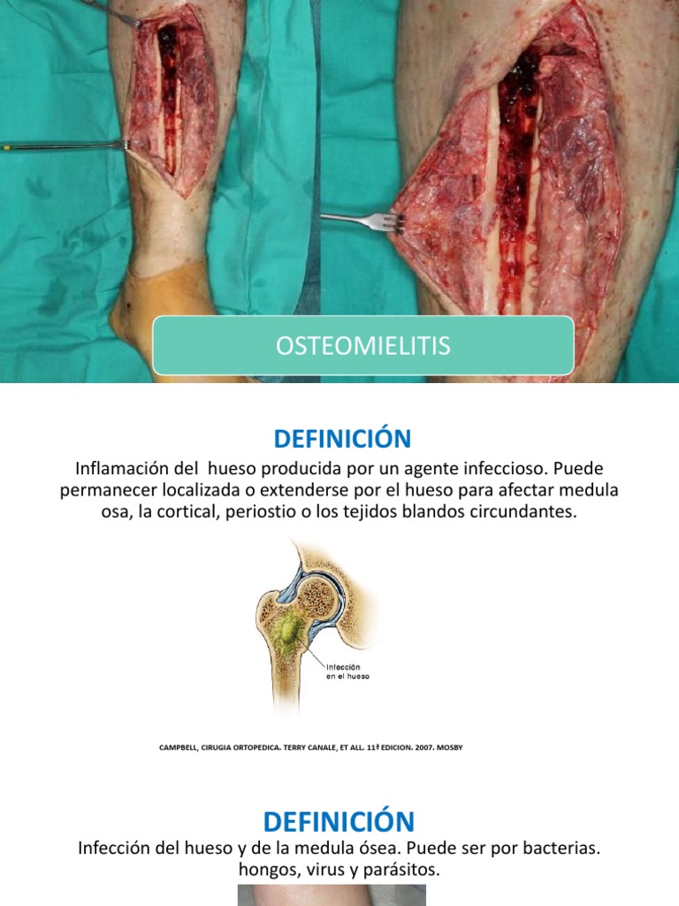 Osteomielitis | Hueso | Inflamación