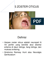 Herpes Zoster Oticus