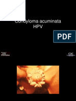 Condyloma Acuminata