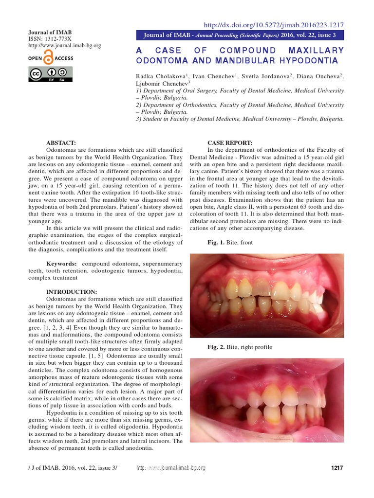 Odontoma Compound 1 Tooth Mouth
