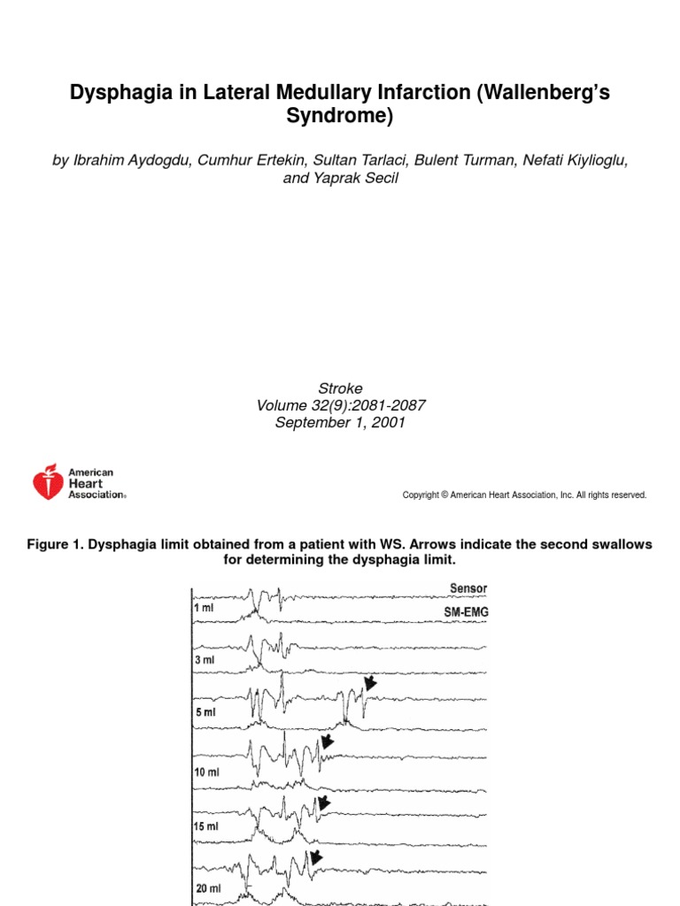 Recovery Of Dysphagia In Lateral Medullary Stroke – YUND