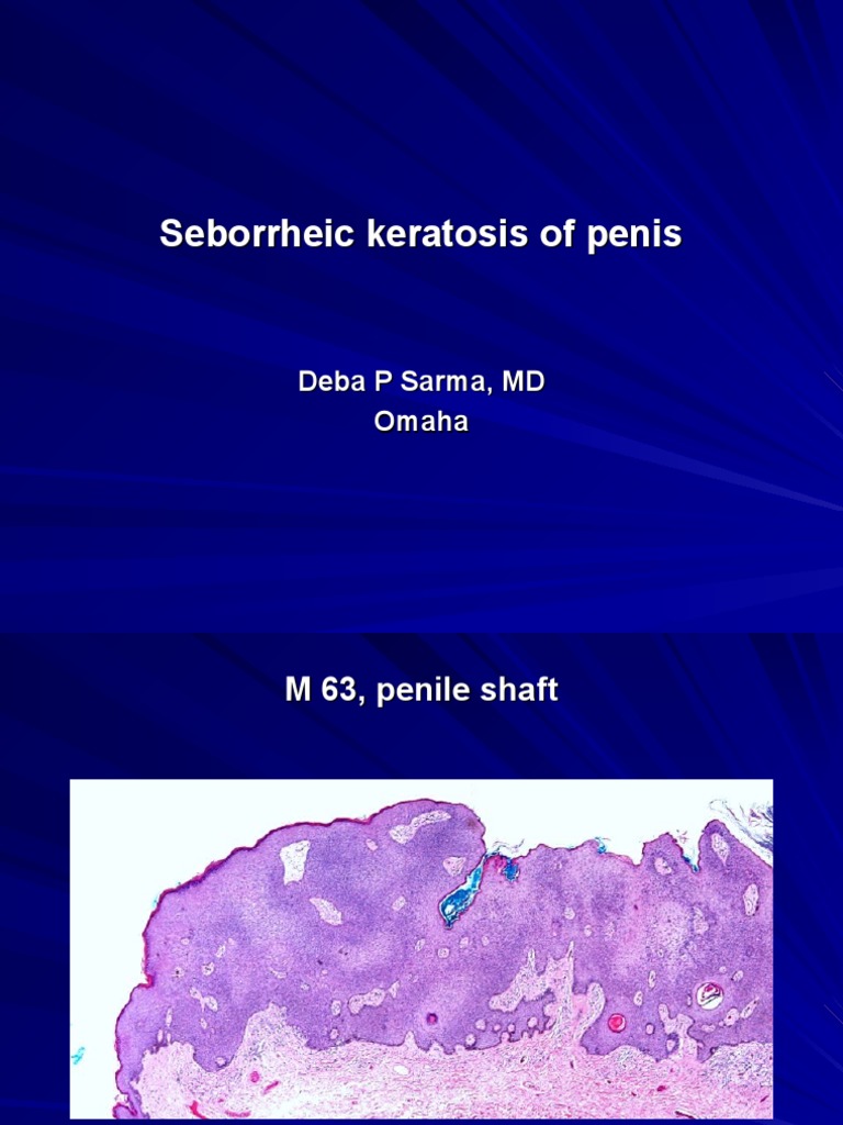 Seborrheic Keratosis on Penis: Case Study | PDF | Science & Mathematics