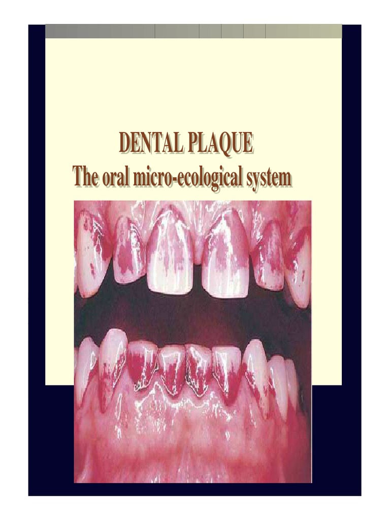 Local Plaque and Plaque Retentive Factors. 2013ppt Periodontology