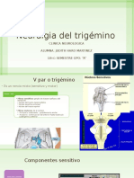 Neuralgia Del Trigemino