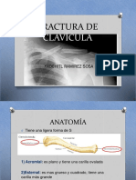 Fractura de Clavícula