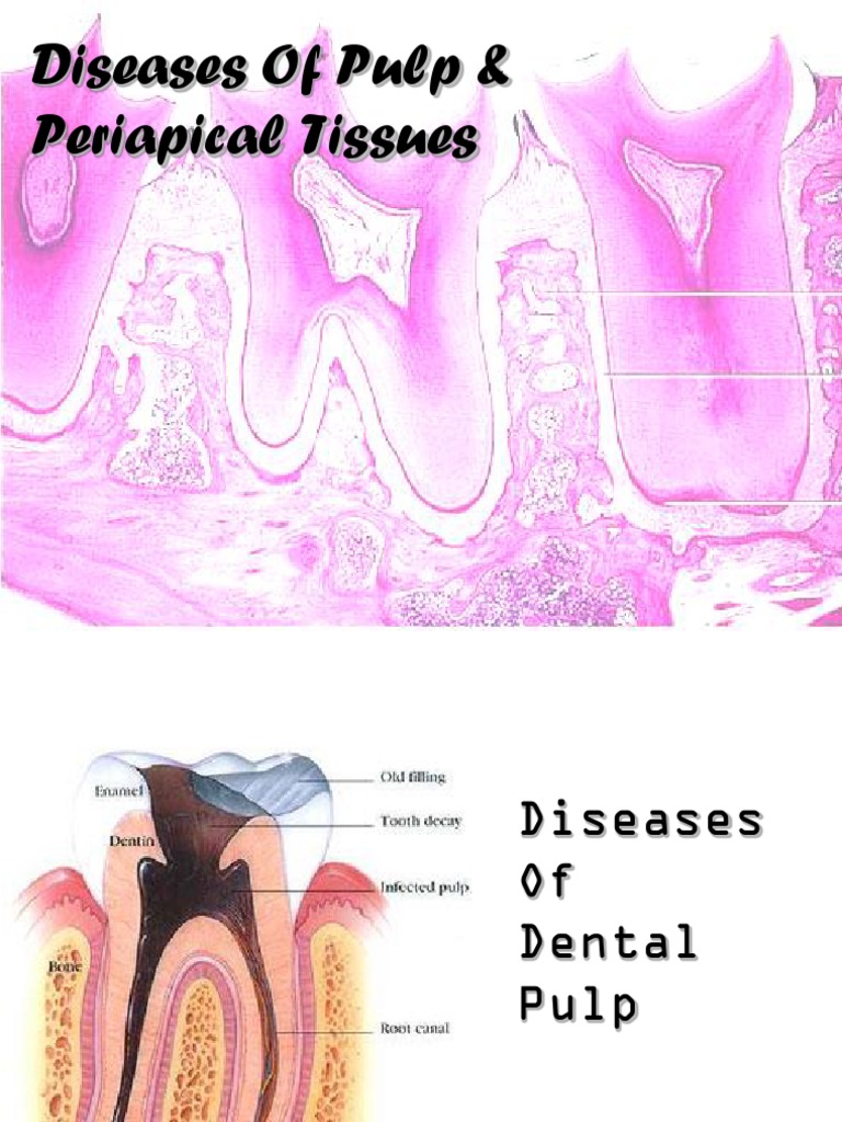 Diseases of Pulp and Periapical Inflammation Diseases And Disorders