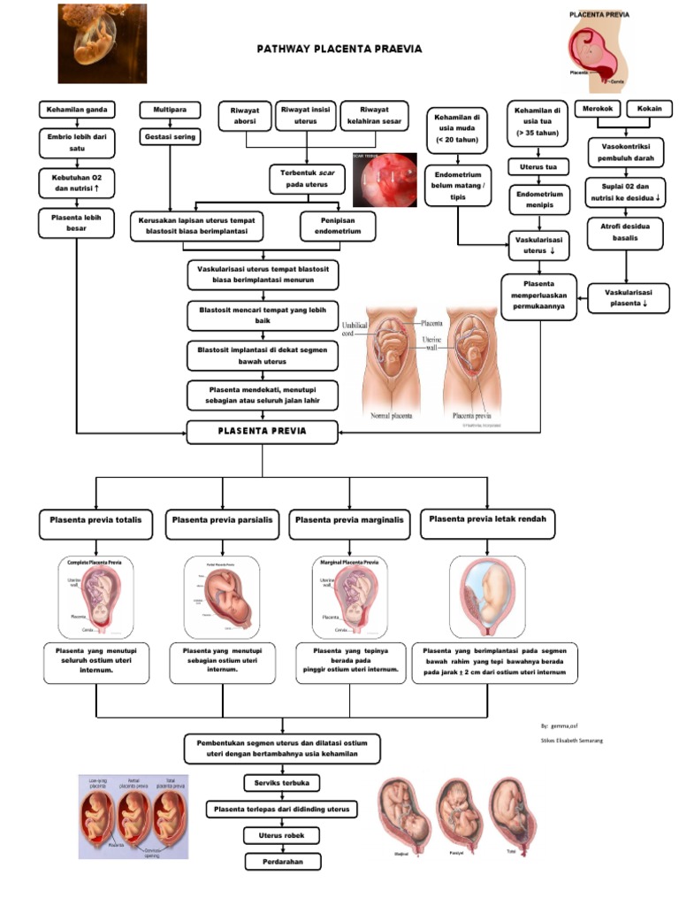 Pathway Plasenta Previa dan Patofisiologi | PDF
