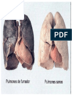 pulmones fumador.pptx