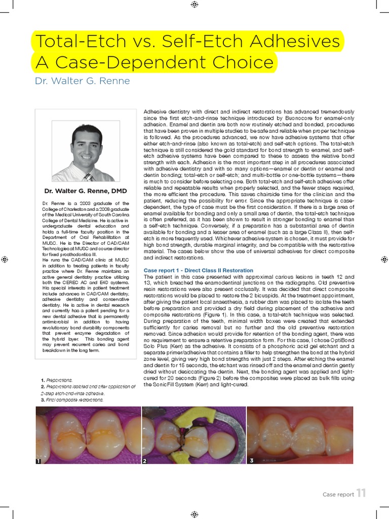Total Etch Vs Self Etch Adhesives PDF PDF Dental Composite Dentistry