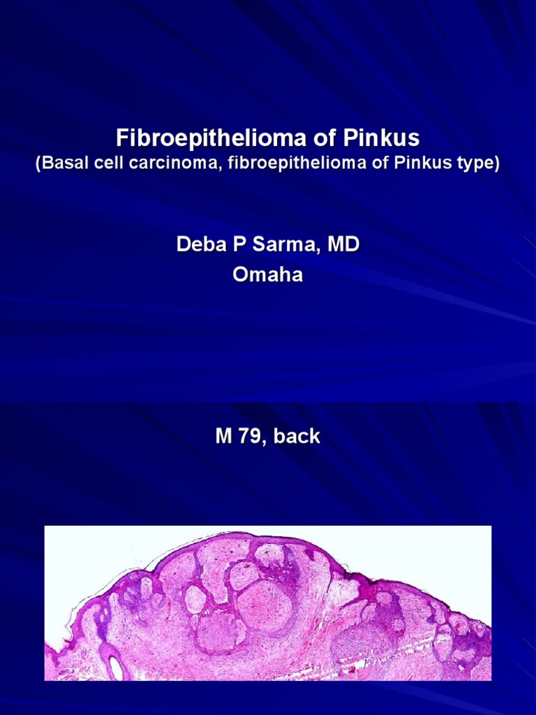 Fibroepithelioma of Pinkus (Basal Cell Carcinoma, Fibroepithelioma of Pinkus Type), M 79, Back