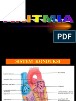 Ekg Aritmia