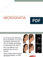 Micrognatia