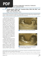 A Tooth-Stabilized Surgical Template For Alveolectomy