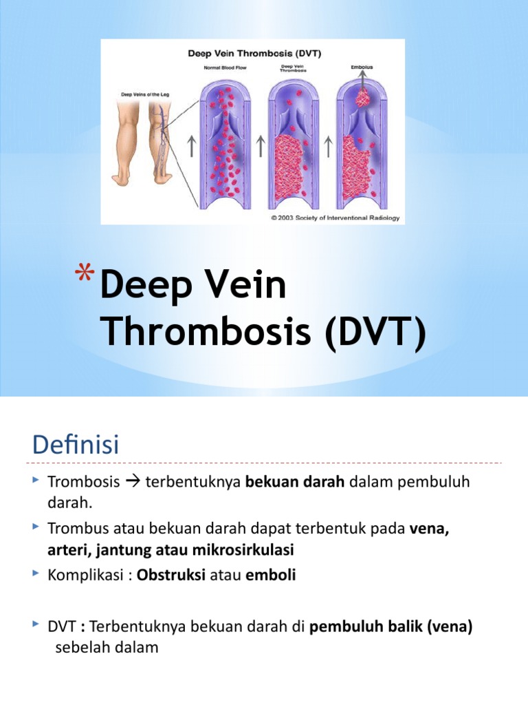 Penatalaksanaan Deep Vein Thrombosis | PDF