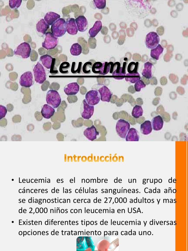 leucemias y linfomas en pediatria.pptx | Leucemia | Linfoma
