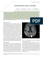 Cerebrovascular Ischaemia After Carbon Monoxide Intoxication PDF