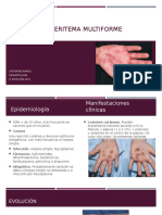 Síndrome de Eritema Multiforme