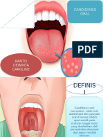 Kandidiasis Oral