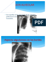 Lesiones Alveolares