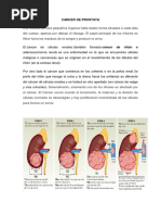 Cancer de Prostata