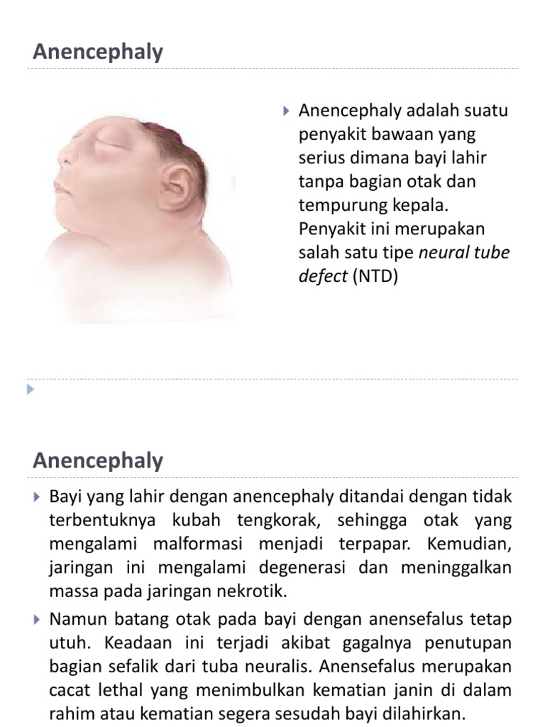 Anencephaly | PDF