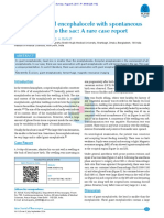 A Giant Occipital Encephalocele With Spontaneous Hemorrhage Into The Sac - A Rare Case Report