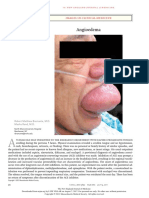 Angioedema: Images in Clinical Medicine